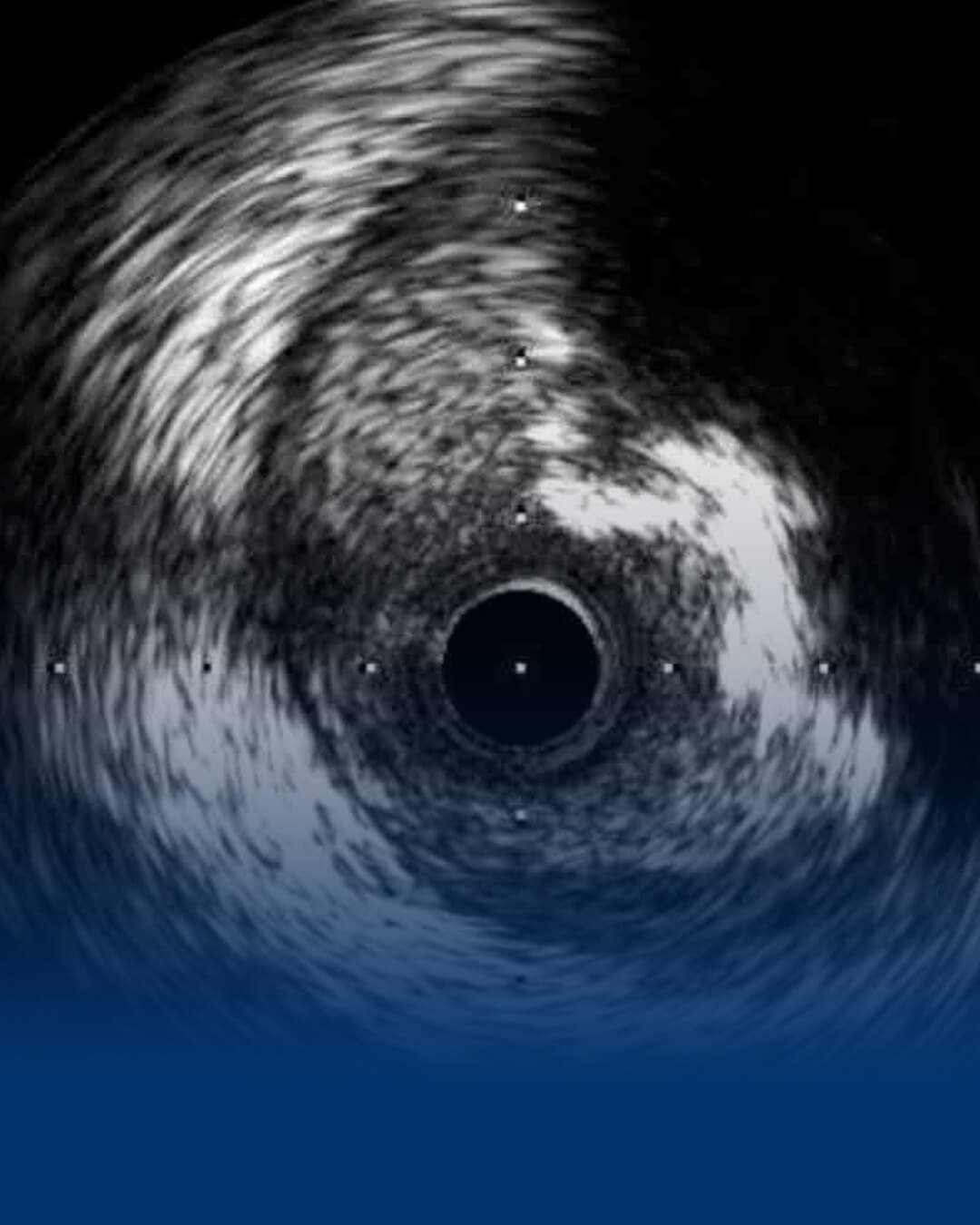 Damar İçi Ultrason (IVUS)