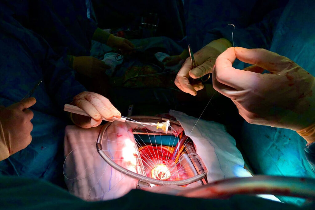 Mekanik Kapak Protezi Hangi Durumlarda Kullanılır?