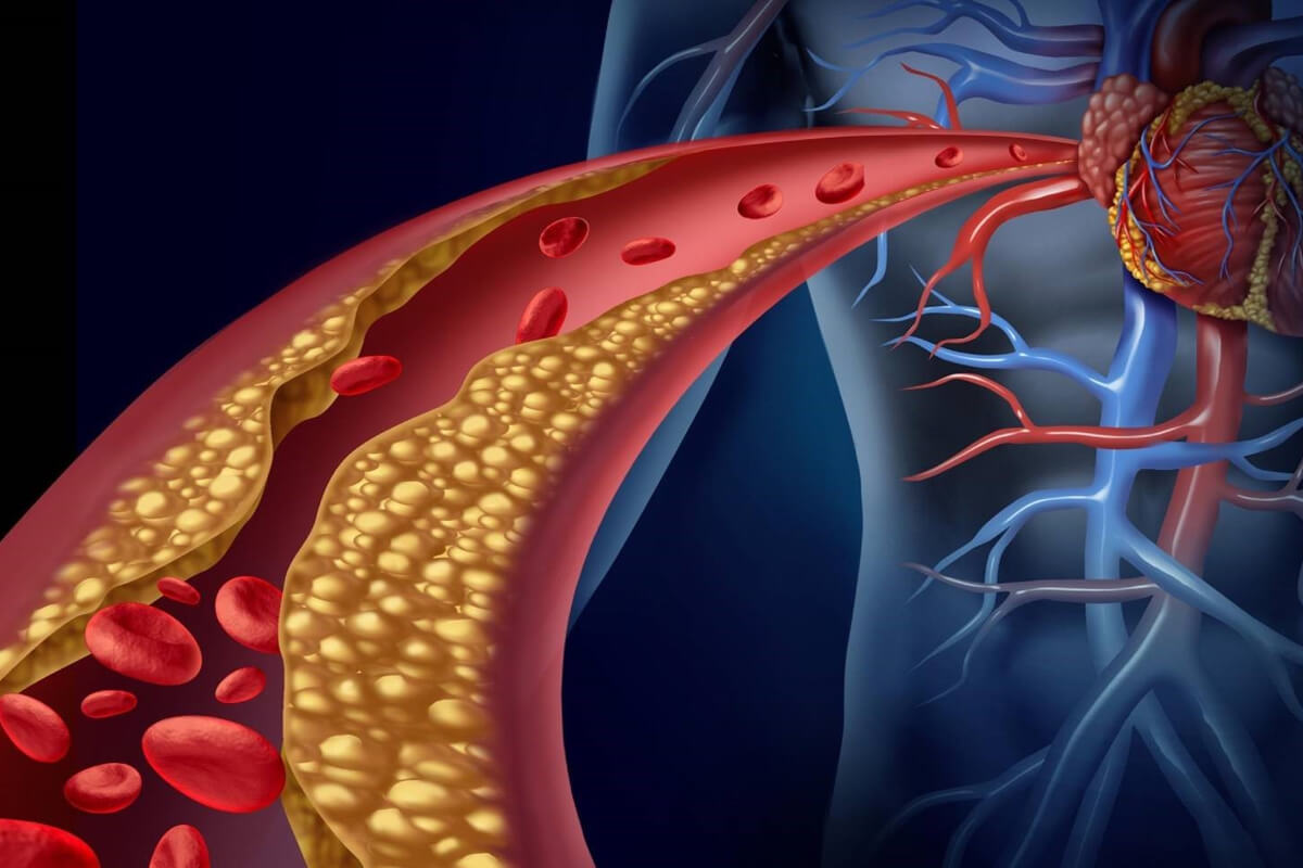 Yüksek Kolesterolden Korunmak İçin Bunlara Dikkat!